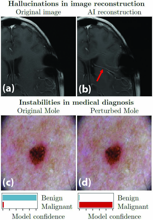 <strong>Figure 1.</strong> Hallucinations in image reconstruction and instabilities in medical diagnoses. <strong>1a.</strong> The correct, original image from the 2020 fastMRI Challenge. <strong>1b.</strong> Reconstruction by an artificial intelligence (AI) method that produces an incorrect detail (AI-generated hallucination). <strong>1c.</strong> Dermatoscopic image of a benign melanocytic nevus, along with the diagnostic probability computed by a deep neural network (NN). <strong>1d.</strong> Combined image of the nevus with a slight perturbation and the diagnostic probability from the same deep NN. One diagnosis is clearly incorrect, but can an algorithm determine which one? Figures 1a and 1b are courtesy of the 2020 fastMRI Challenge [10], and 1c and 1d are courtesy of [6].