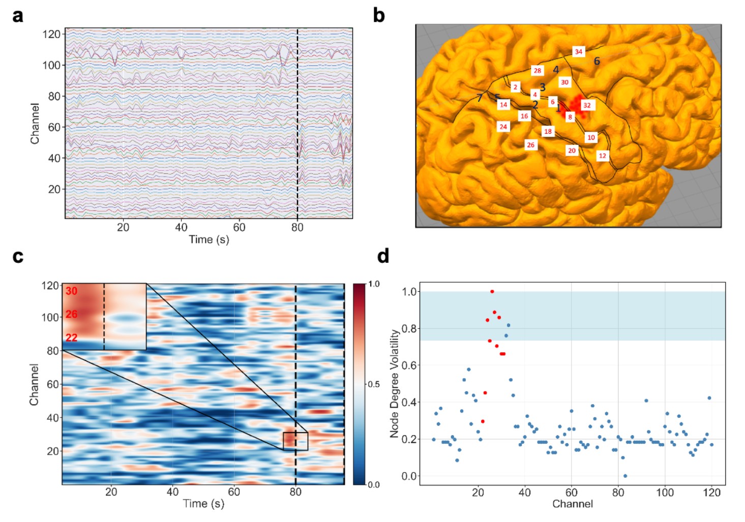 <strong>Figure 2.</strong> Node degree volatility identifies seizure onset zone channels in representative successful surgery case. <strong>2a.</strong> iEEG recording of a single seizure episode of Patient 0; channel contacts on the y-axis and time (in seconds) on the x-axis. The black dashed line indicates seizure onset, as determined by clinical observation. <strong>2b.</strong> Surgeon-annotated regions of Patient 0. Labels correspond to the depth electrodes placed by the surgeon according to presurgical evaluation; on average each electrode is equipped with seven channels. The red region localized in the primary somatosensory cortex by symptomatic tingling of the left thumb. The clinically annotated seizure onset zone (SOZ) contacts span electrode Pin 8. <strong>2c.</strong> Heat map of node degree volatility over time. Inset highlights particular nodes with high node degree volatility that correspond to the clinically identified SOZ. <strong>2d.</strong> Maximum of the absolute value of node degree volatility within a 16-second window centered on seizure onset. Red circles denote SOZ channels; blue circles denote non-SOZ channels. Four SOZ nodes (23, 25, 26, and 28) fall within the top five percent of the distribution (shaded blue region). Figure courtesy of [6]. 