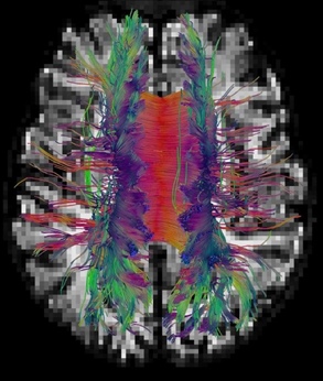 <strong>Figure 1.</strong> Bundles of neural fibers reconstructed from dMRI measurements.