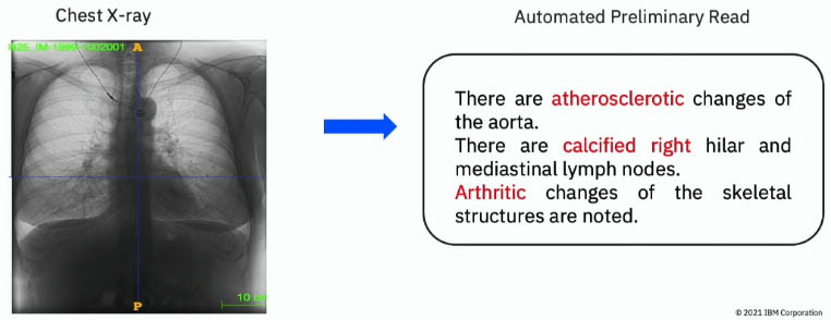<strong>Figure 1.</strong> An example of an automated preliminary read with a fine-grained description that was created by the artificial intelligence platform from a chest X-ray image. Figure courtesy of Tanveer Syeda-Mahmood.