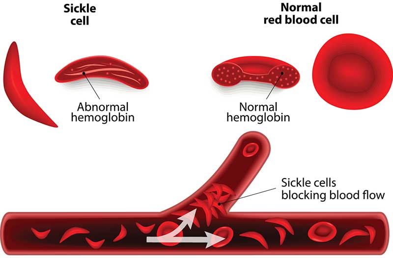 <strong>Figure 1.</strong> Sickle cell disease (SCD) is a group of genetic red blood cell disorders wherein an abnormal type of hemoglobin causes the cells to become hard, sticky, and sickle shaped. Figure courtesy of <a href="https://www.froedtert.com/sickle-cell-disease/symptoms">Froedtert and the Medical College of Wisconsin regional health network</a>.