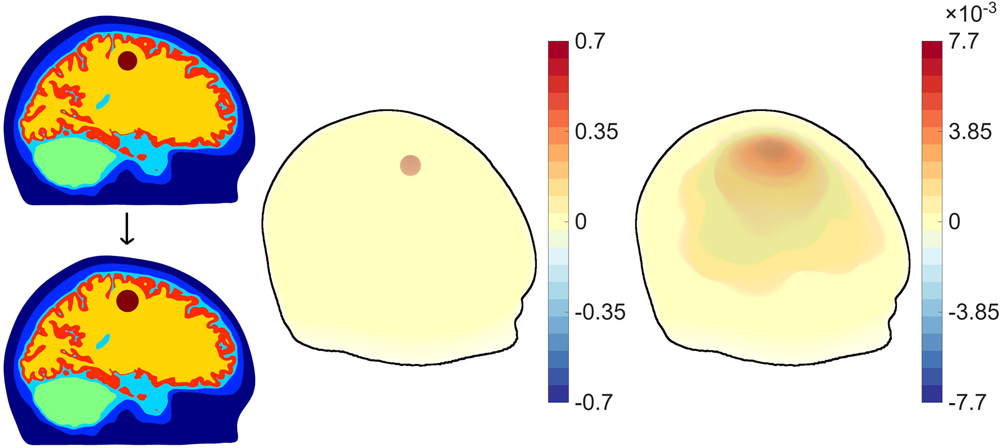 <strong>Figure 2.</strong> Electrical impedance tomography can track the evolution of simulated hemorrhage in the brain, which supports the clinical application of continuous monitoring techniques for intensive care patients. Figure courtesy of Jussi Toivanen.