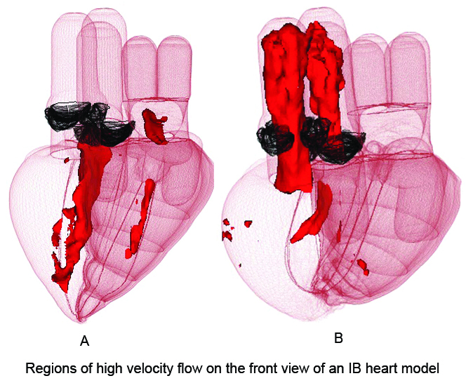 <strong>Figure 3.</strong> Snapshot of a visualization of regions of high velocity flow on the front view of an IB heart model stimulated by electrical activity. The red color indicates regions in which the magnitude of the velocity is above an arbitrarily chosen threshold. A is in diastole with blood entering the ventricles through the mitral and tricuspid valves. B is in systole, with blood being ejected from the ventricles through the aortic and pulmonic valves. In both frames the thin-walled right ventricle is on the left side of the figure. Image credit: Boyce Griffith, David McQueen, and Charles Peskin.