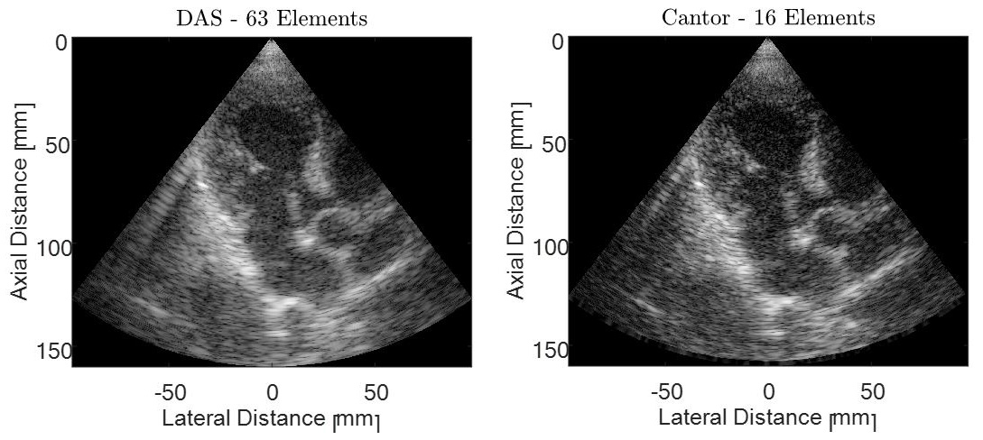 &lt;strong&gt;Figure 2.&lt;/strong&gt; The same cardiac image obtained with delay-and-sum beamforming using a uniform linear array of 63 elements (left) and convolutional beamforming using a sparse array of 16 elements (right). Image courtesy of [4].
