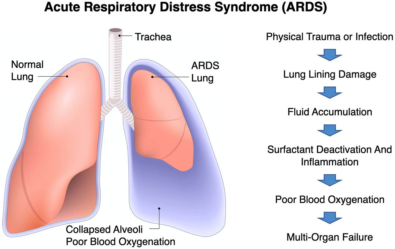 <strong>Figure 1.</strong> Visual description of acute respiratory distress syndrome (ARDS) and its impact on the body. Public domain image.