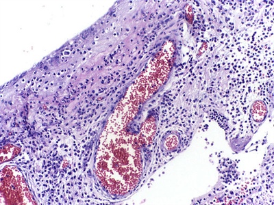 Various cells and mediators are involved in the response to acute inflammation in the body. Image courtesy of Wikimedia Commons
