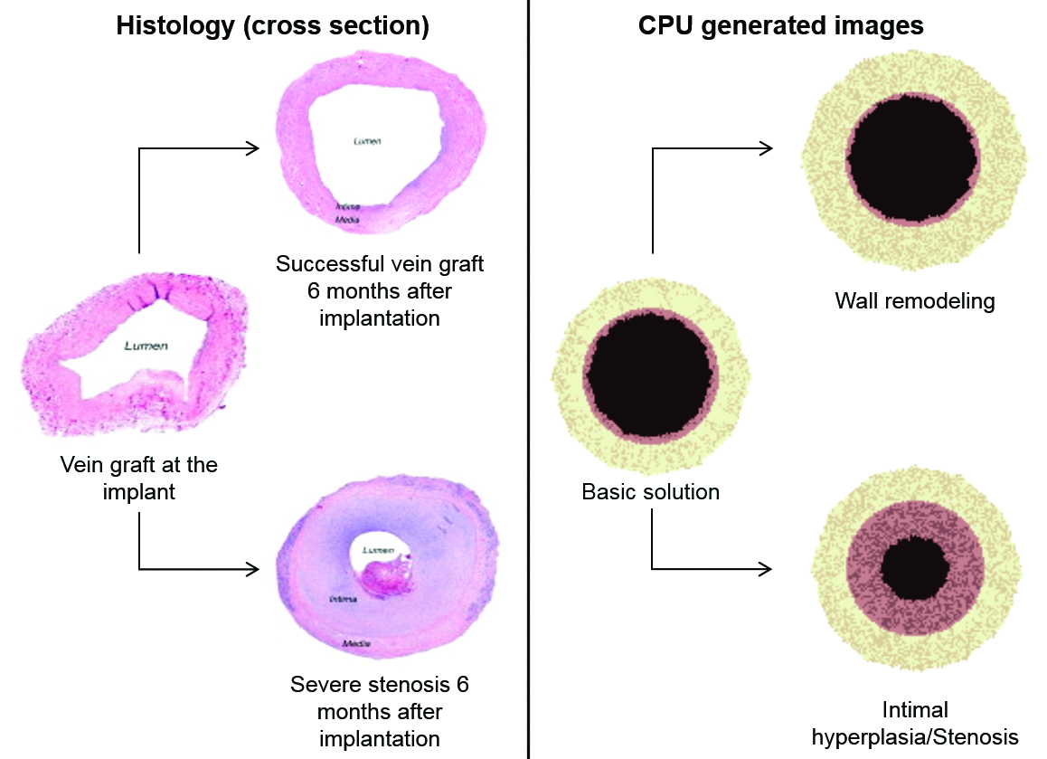 <strong>Figure 3.</strong> Clinical observation of a vein graft success and failure six months after surgery (left), replicated with an agent-based model (right). The black portion represents the lumen, the pink portion represents the tunica intima, and the beige portion represents the tunica media. Image courtesy of [5].