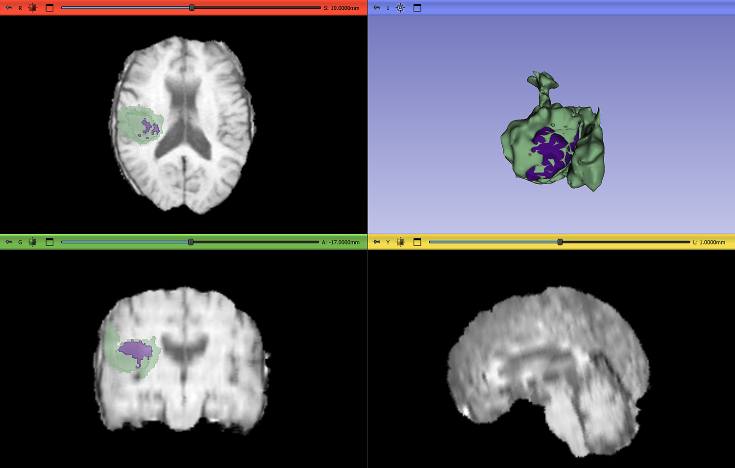 <strong>Figure 1.</strong> Three-dimensional visualization of a brain tumor that includes both enhancing and non-enhancing regions of the brain. Figure courtesy of the author.