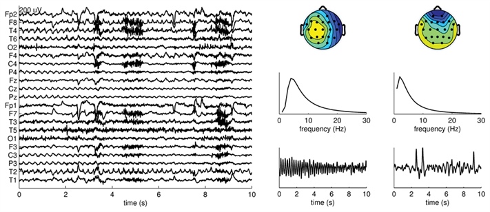 <strong>Figure 2.</strong> At left, CPD of wavelet transformed EEG showing a 10-second onset of a right temporal lobe complex partial seizure. Muscle (at five and nine seconds) and eye blink artefacts (sharp wave) are visible. At right, the spatial (top), frequency (middle), and temporal modes (bottom) are shown. The epileptic atom is on the left, the eye blink artefact on the right. Adapted from [5].