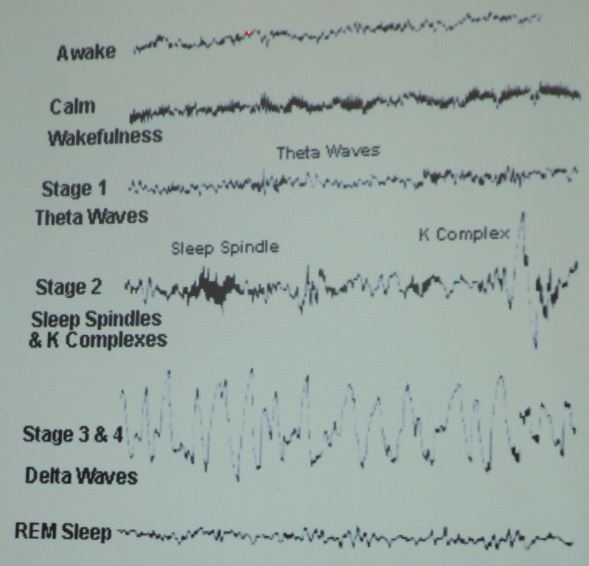 Brain activity under the following stages of wakefulness: fully awake, calm wakefulness, non-REM stages 1 and 2, deeper stages 3 and 4, and REM sleep. The patterns of REM sleep and wakefulness look remarkably similar. Image credit: Alicia Prieto Langarica, AN17 presentation.