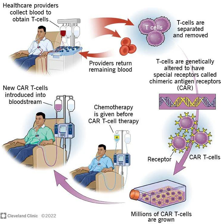 <strong>Figure 1.</strong> Explanation of chimeric antigen receptor (CAR) T-cell therapy in the treatment of melanoma and other cancers. Figure courtesy of the <a href="https://my.clevelandclinic.org/health/treatments/17726-car-t-cell-therapy">Cleveland Clinic</a>.