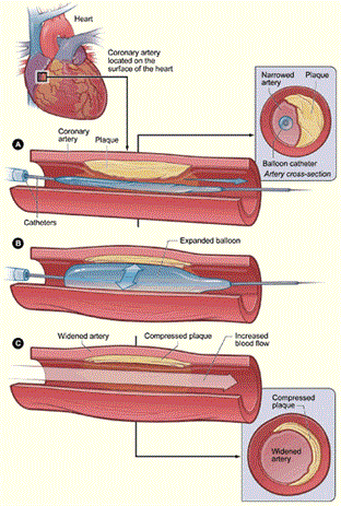 Illustration of a cross-section of a coronary artery with plaque buildup. The coronary artery is located on the surface of the heart. ‘A’ shows the deﬂated balloon catheter inserted into the narrowed coronary artery. The balloon is inﬂated in ‘B’—this compresses the plaque and restores the size of the artery. ‘C’ shows the widened artery. Image source: National Heart, Lung, and Blood Institute; National Institutes of Health; U.S. Department of Health and Human Services.