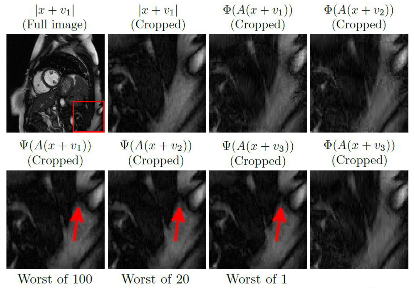 <strong>Figure 3.</strong> The deep MRI network [8] is unstable with respect to Gaussian noise and produces false image regions. 100 Gaussian noise vectors \(w_j \in \mathbb{C}^{N}\) were computed, then the eyeball metric was used to pick the one (subsequently labeled \(v_1\)) for which \(\Psi(A(x+w_j))\) yields the largest artifact. This process was then repeated with 20 noise vectors, as well as one new noise vector, to give perturbations \(v_2\) and \(v_3\) respectively. The red arrows indicate that \(\Psi\) introduces a false dark area. Poor conditioning does not cause this instability since \(\mathrm{cond}(AA^*) = 1\) as before. Conversely, the sparse regularization method \(\Phi\) accurately recovers the image without the false region. Figure courtesy of [4].