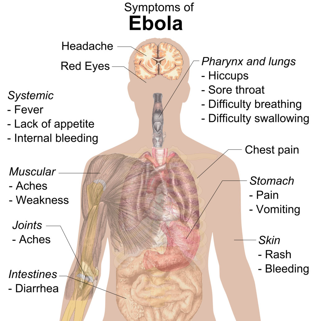 After initially experiencing headache, fatigue, and/or muscle soreness, Ebola patients develop a high fever, internal bleeding, and the possible shutting down of organs. Image credit: Wikimedia Commons.