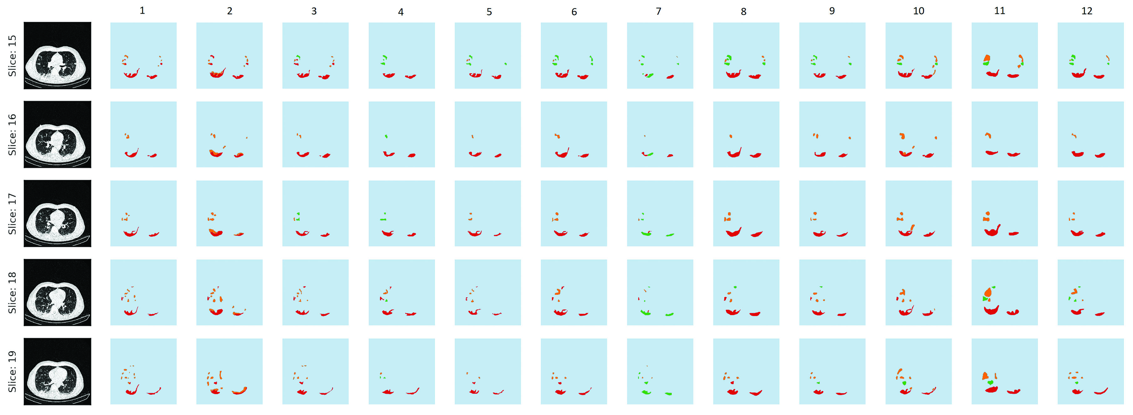 <strong>Figure 3.</strong> Variability between 12 physicians who segmented the same image slices.