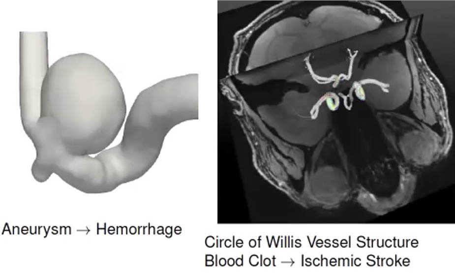 <strong>Figure 1.</strong> Examples of cerebrovascular diseases that arise due to issues with blood vessels in the brain. Figure courtesy of Sahani Pathiraja.