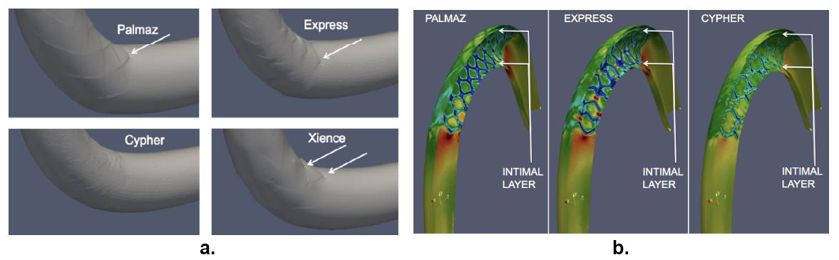 <strong>Figure 3. 3a.</strong> The intimal layer with four different stents showing possible damage to the intima. <strong>3b.</strong> Stress experienced by the intima; red designates excessive elastic deformation and blue represents resistance to deformation. The colors indicate deviation from normal stress values (green). Cypher-like stents have the best performance. Figure courtesy of Sunčica Čanić research group.