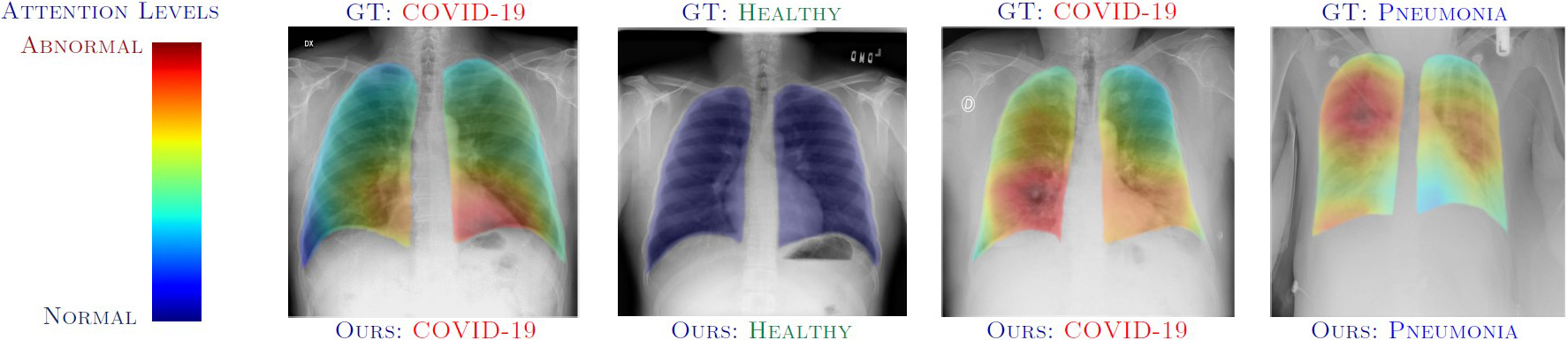 &lt;strong&gt;Figure 6.&lt;/strong&gt; Attention maps on chest X-ray images that are overlaid with our prediction output (bottom) and the ground truth (GT) human consensus prediction (top). These maps highlight normal and abnormal regions, thus aiding radiologists in the decision-making process. Figure courtesy of [3].