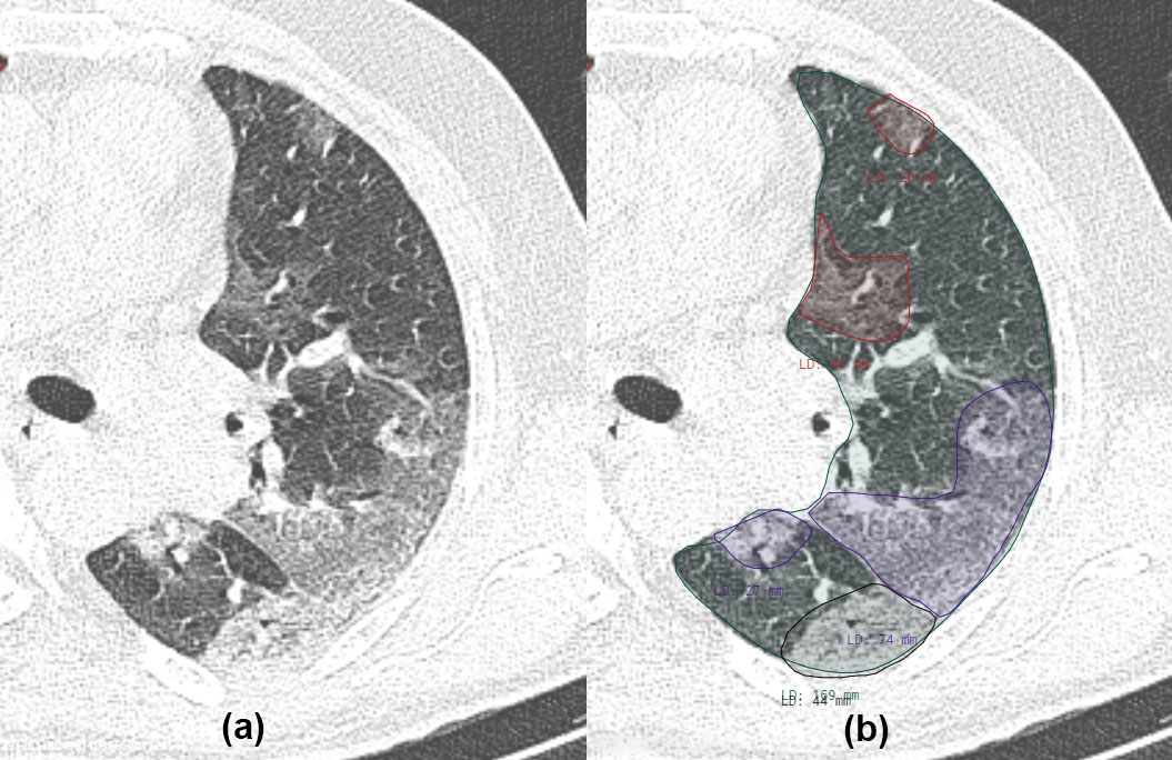 <strong>Figure 1.</strong> Visualization of an axial slice of a computed tomography (CT) scan, cropped to the left lung. <strong>1a.</strong> Pulmonary opacification present in a patient with COVID-19. <strong>1b.</strong> The corresponding annotation generated by a radiologist. Red indicates pure ground-glass opacity (GGO), purple designates GGO with intralobular lines (crazy paving), and black signifies consolidation.