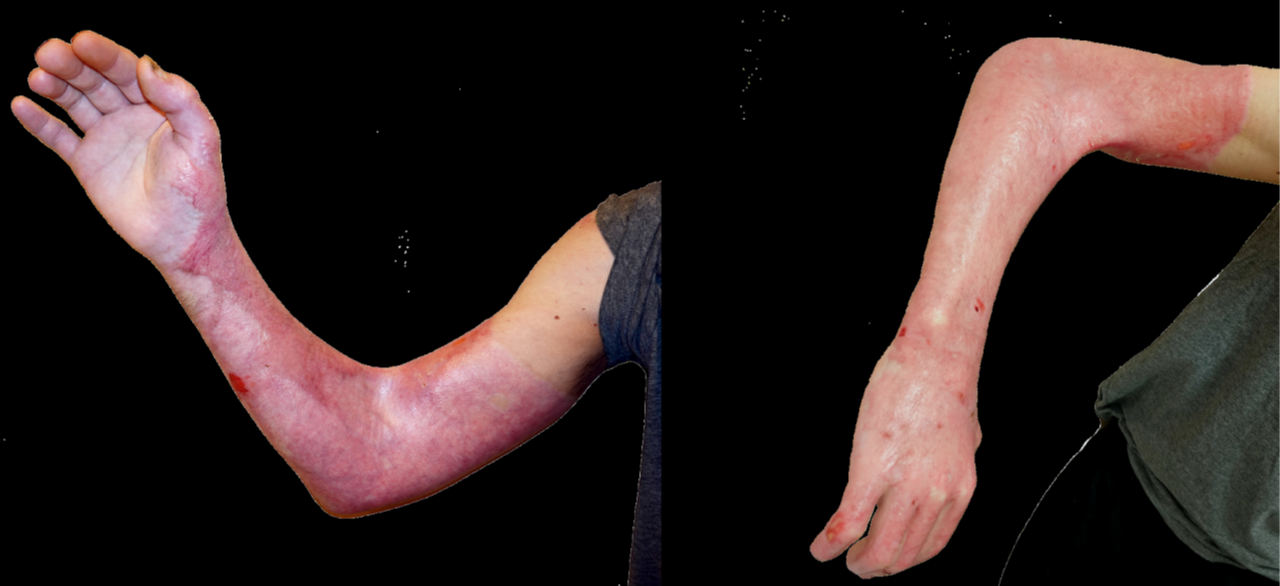 <strong>Figure 1.</strong> Example of a burn injury wherein the contraction limits the movement of the patient’s elbow. Figure courtesy of Paul van Zuijlen.