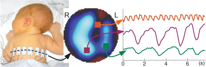&lt;strong&gt;Figure 2.&lt;/strong&gt; Deep neural networks make it possible for practitioners to utilize a hemiarray of eight electrodes—rather than the full set of 16—to detect anomalies in medically fragile patients, such as premature infants or those with abdominal trauma. Figure courtesy of [1].