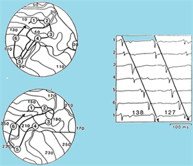 This graphic, taken from Alessie et al. 1977 shows the initial animal experiments of electrodes placed on atrial tissue (#1-6, discs) during fibrillation and the procession of wavefronts around varying anatomic barriers. High-resolution real-time mapping in beating human hearts could offer cardiologists a tool to help target areas that sustain atrial fibrillation.