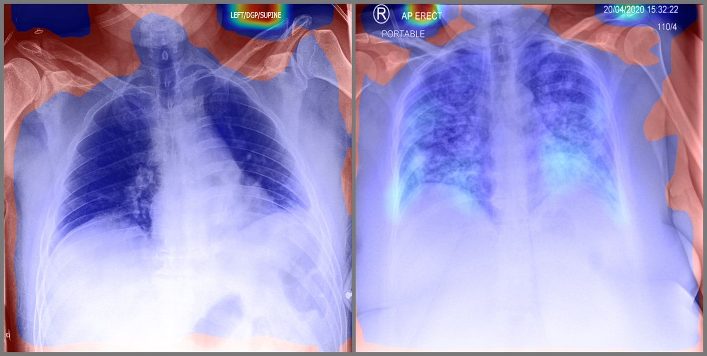 <strong>Figure 3.</strong> Activation map depicting regions of interest for a neural network that detects lung abnormalities. Red areas indicate discriminative regions that the model uses to make its predictions. Original scans courtesy of the National Collaborating Centre for Infectious Diseases dataset [8].
