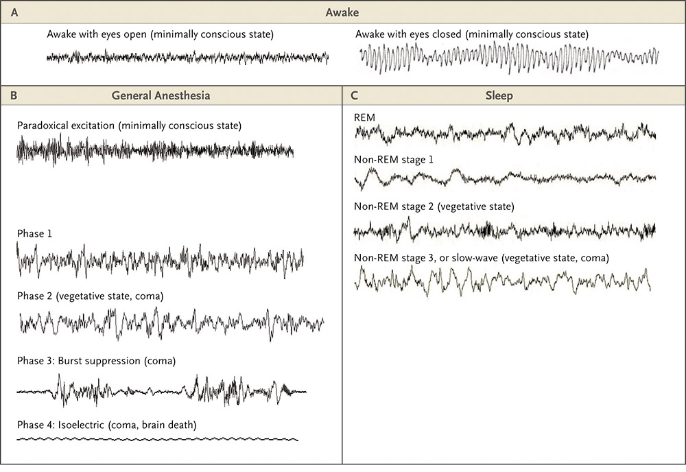 EEG-wise, general anesthesia has more in common with being in a coma than with being asleep, but patients prefer the latter, more reassuring term. Emery Brown is among the researchers who are studying mathematically what happens in the brain when drugs like propofol are administered. Reprinted with permission from “General Anesthesia, Sleep, and Coma,” December 10, 2010, New England Journal of Medicine, copyright 2013.