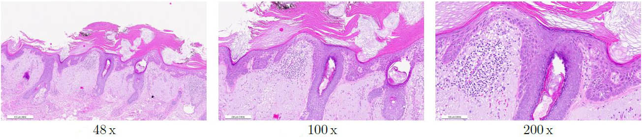 <strong>Figure 2.</strong> Three image patches with the same resolution that were extracted at different magnification levels. Figure courtesy of Centroderm and aisencia.