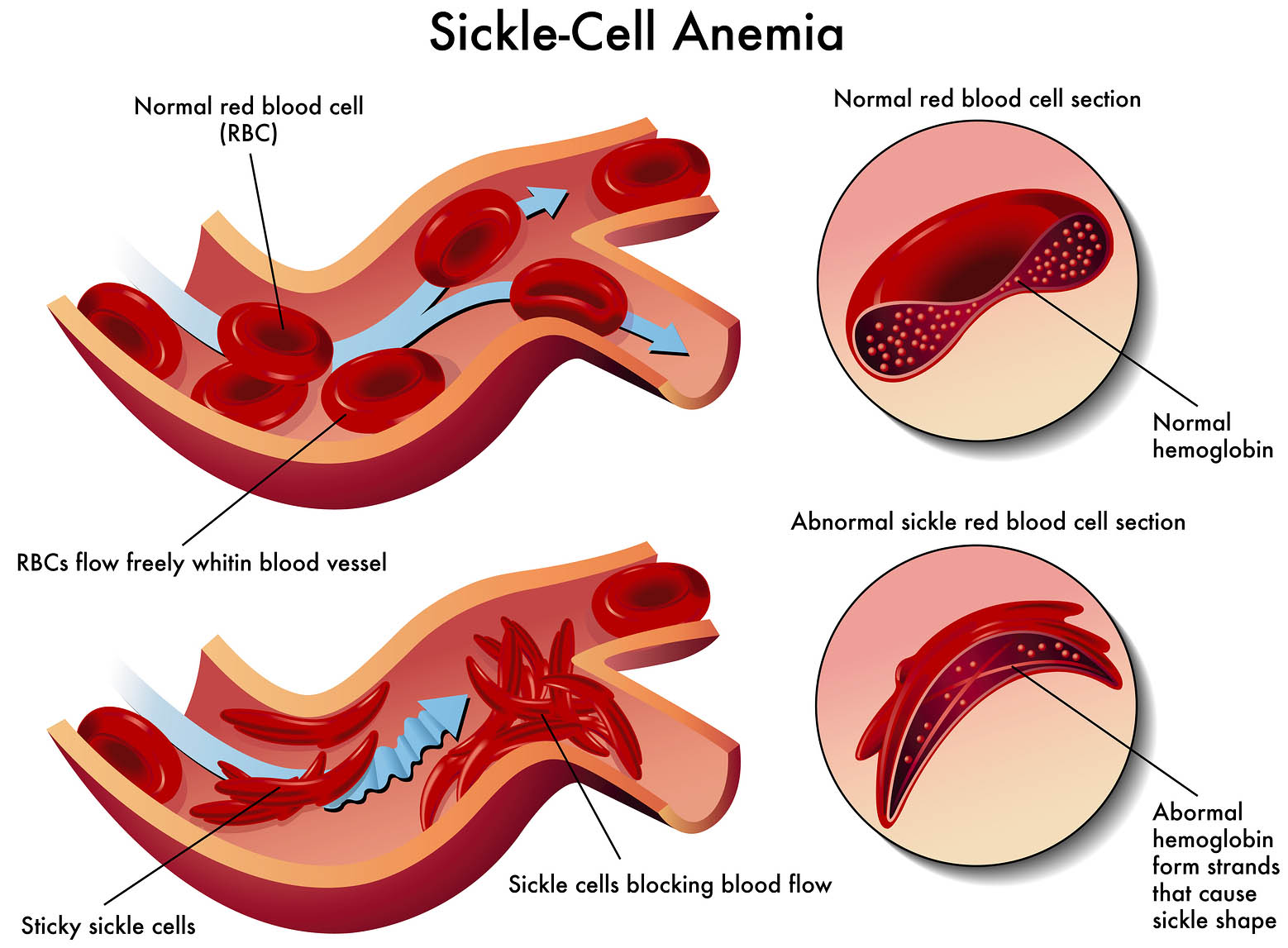 Explanation of sickle-cell anemia. Image credit: Diana Grib (Creative Commons Attribution-Share Alike 4.0 International license).